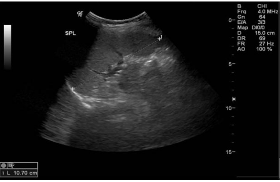 Drug-Induced Hepatitis Following Albendazole Use: A Case Report and Literature Review