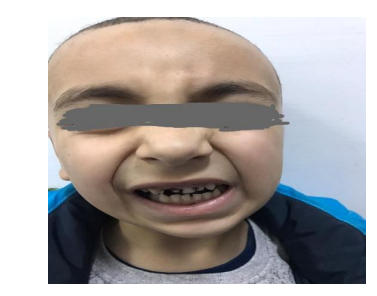 Our Experience With Retrograde Intubation in Ankylosis of the Temporomandibular Joint in a Child Of Six Years
