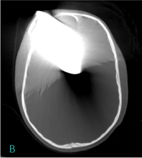 Penetrating Craniocerebral Injury With a Retained Axe Blade: A Case Report
