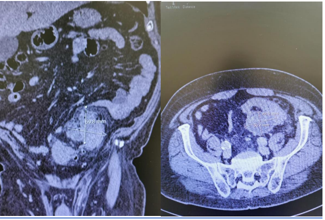 Metastatic Lung Cancer Presenting as Perforated Colon DiverticulitisA Case Report