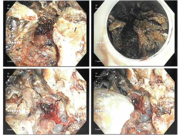 A Case of Extensive Granulation: An Ignored Tracheostomy