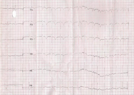 A Rare Presentation of Prinzemetal Angina in Makurdi Nigeria: Case Report and Review of The Literature