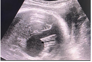 Galen Vein Aneurysm: Case Report