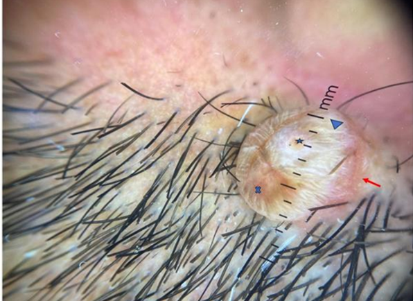 Chondroid Syringoma: Dermoscopic Features and Diagnostic Challenges – A Case Report
