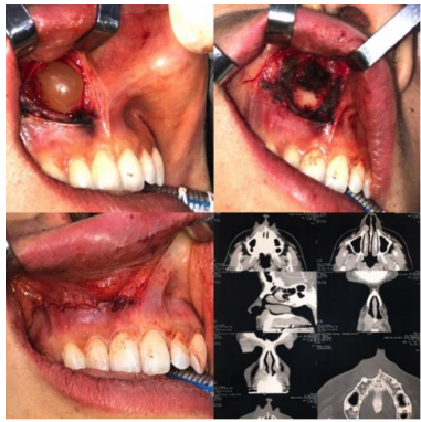 Nasolabial Cyst: A Rare Case Report