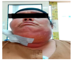 Ludwig Angina in a Comorbid Patient: A Case Report