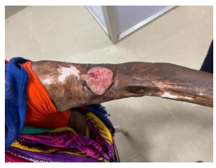 Marjolin’s Ulcer: A Case Report With Review of Literature