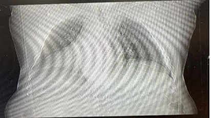 Recurrent Lung Infections Post-Hematopoietic Stem Cell Transplant (HSCT) in a Patient with Chronic Lymphocytic Leukemia (CLL)