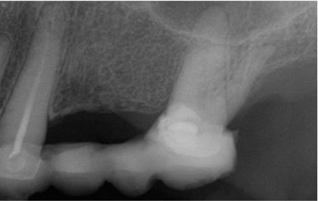 CBCTs, Endo, and the General Practitioner: Maxillary Molars