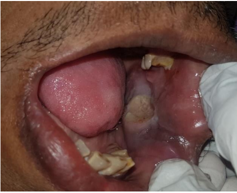 Traumatic Ulcerative Granuloma With Stromal Eosinophilia (TUGSE) – A Diagnostic Enigma