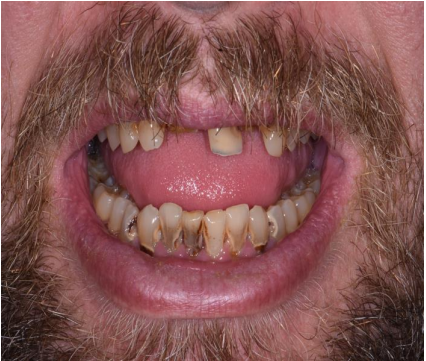 Use of Silver Diamide Fluoride to Manage Rampant Dental Caries and Creating a Path to Oral Health in the Face of Mental Illness: A Case Report
