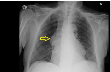 Incidental Finding of Large Mediastinal Mass: Chasing A Diagnosis