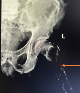 When Mild Is Not Benign: Subtle Hypercalcemia and Confusion Unmasking a Destructive Femoral Lesion in End-Stage Renal Disease