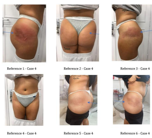 The Impact of the BBL Ban in the UK on Patients Seeking Buttock Augmentation